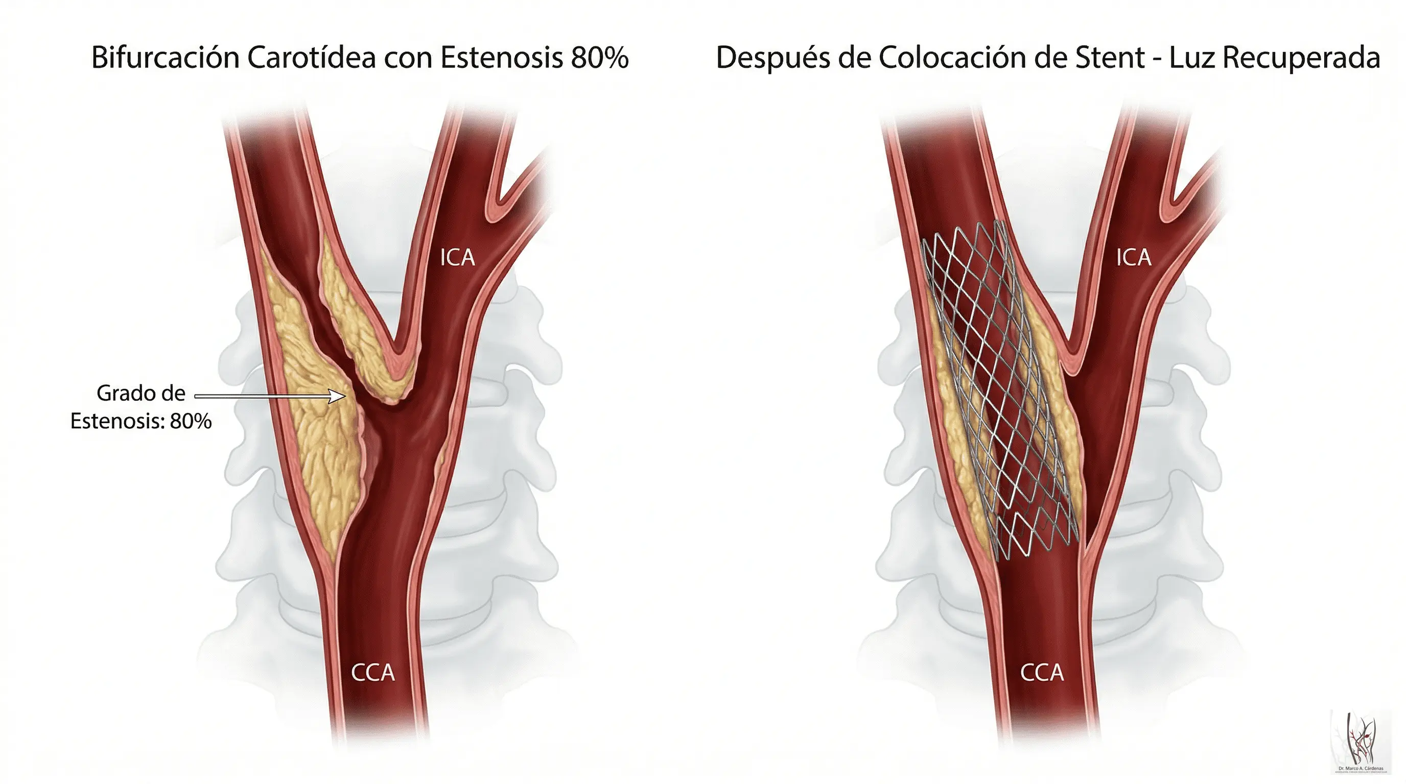 Stent Carotídeo